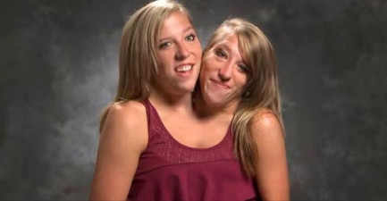 Conjoined-twins-that-reached-worldwide-fame.jpg